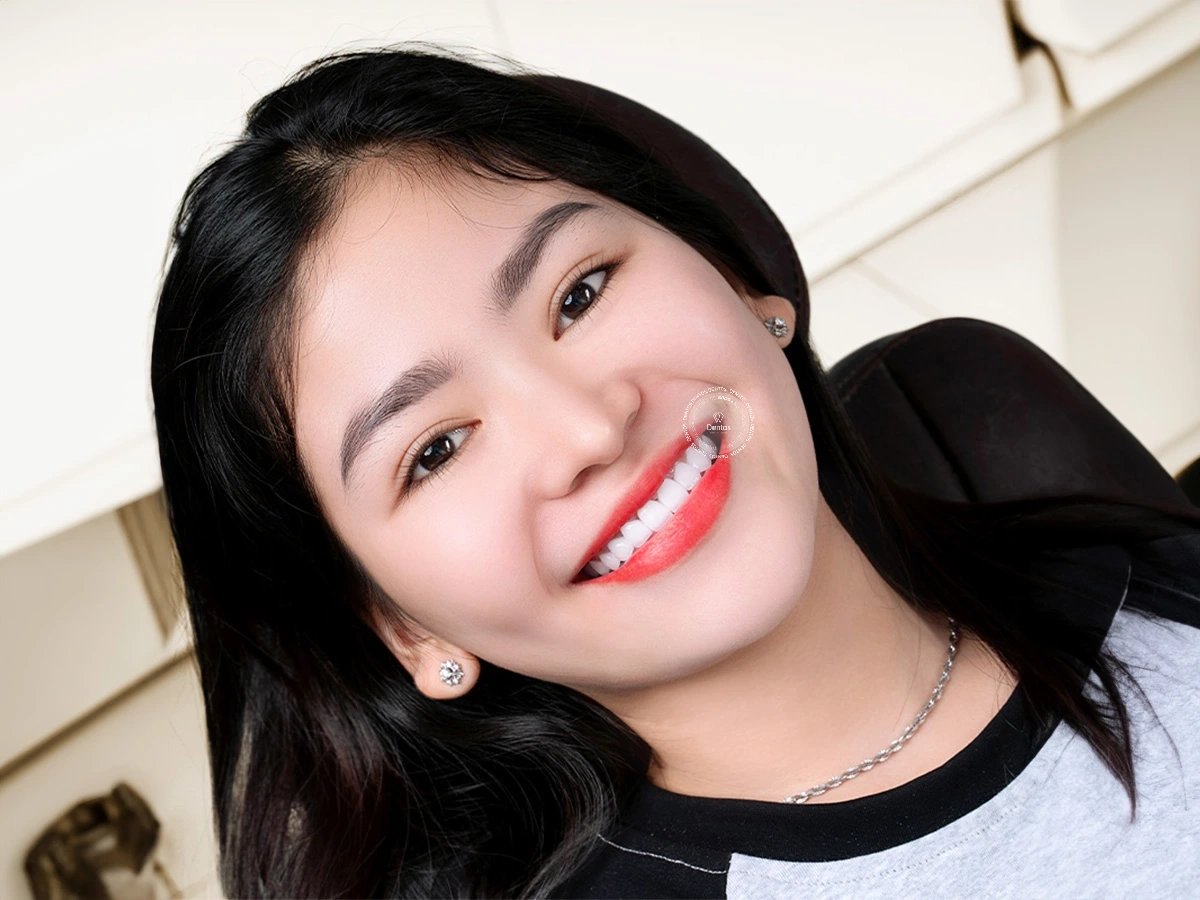 Răng sứ được tinh chỉnh cho đến khi bạn cảm thấy hoàn toàn tự nhiên và thoải mái